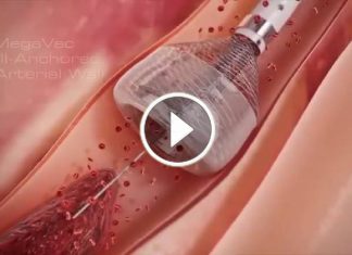Amazing Revolutionary Solution For Clots in Every Vessel